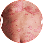 Erythrodermic Psoriasis