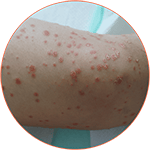 Guttate Psoriasis