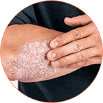 Plaque Psoriasis