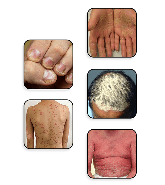Common Signs and Symptoms of Psoriasis